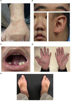 Case report: Macrophage activation syndrome in a patient with Kabuki syndrome